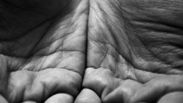 Hiperhidrosis