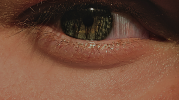 Relleno de ojeras