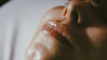 Dermapen