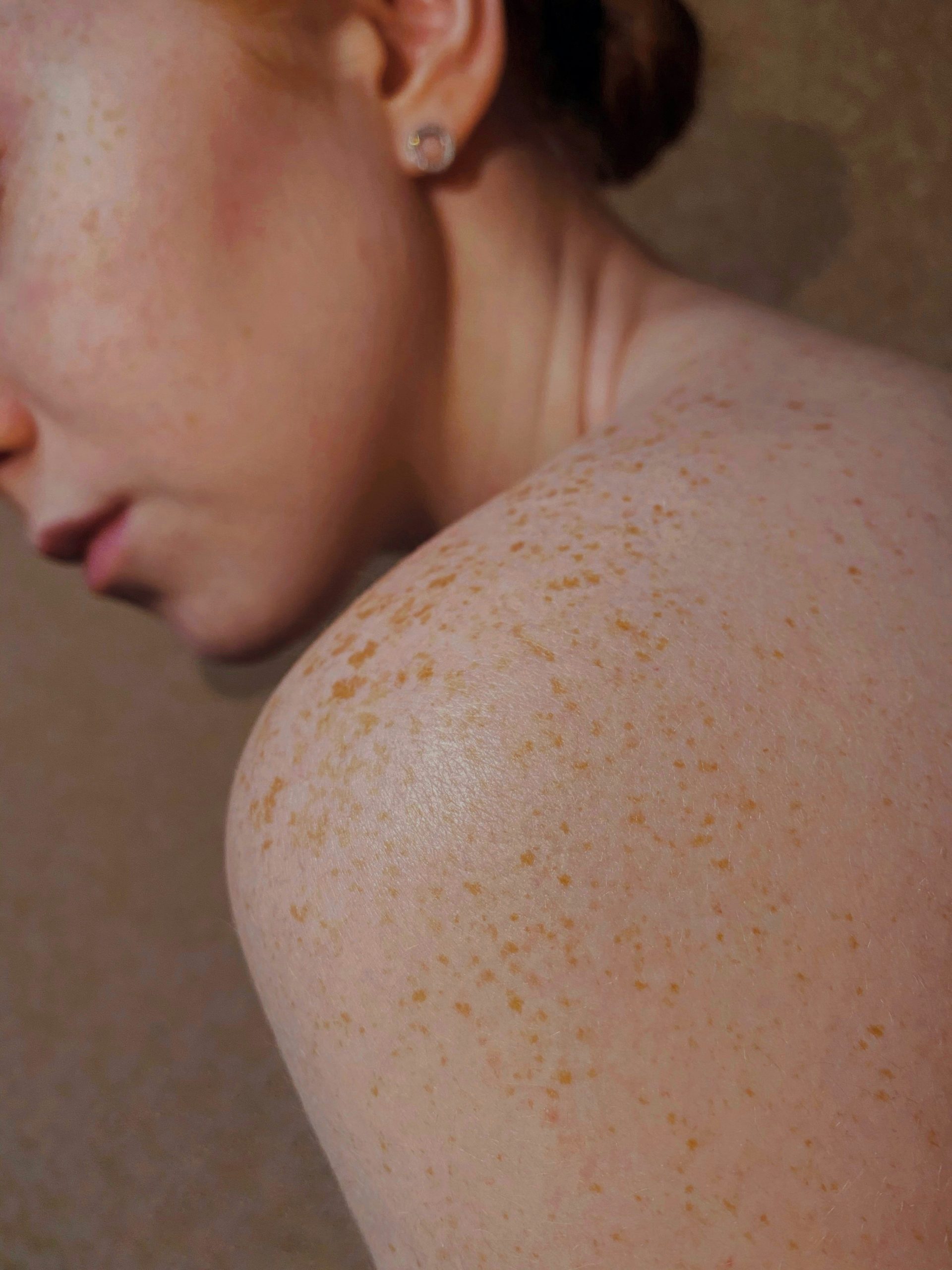 dermatitis atópica en invierno